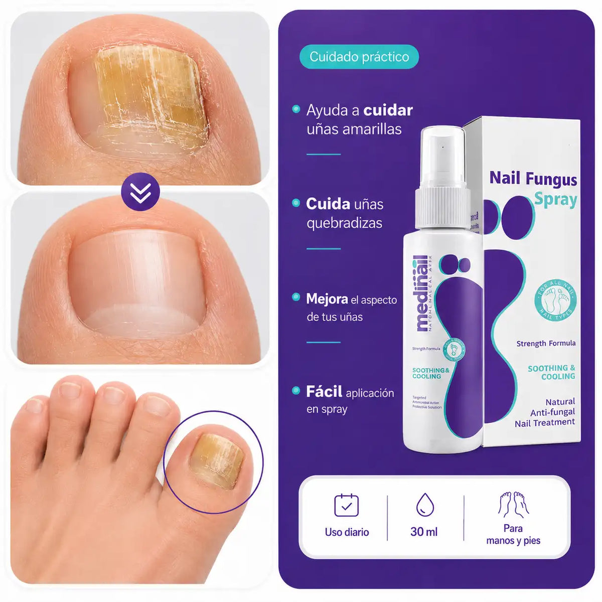 Medinail - Spray Antifúngico - Dile adiós a los hongos y malos olores.